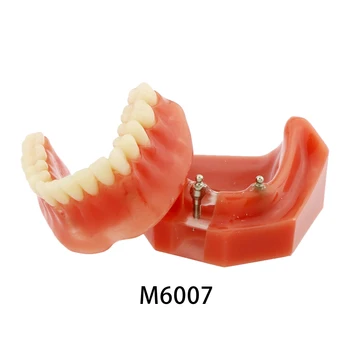 Стоматологичен имплант Typodont M6007 Модел на челюстта за възстановяване на зъбната протеза Горните 2 импланта